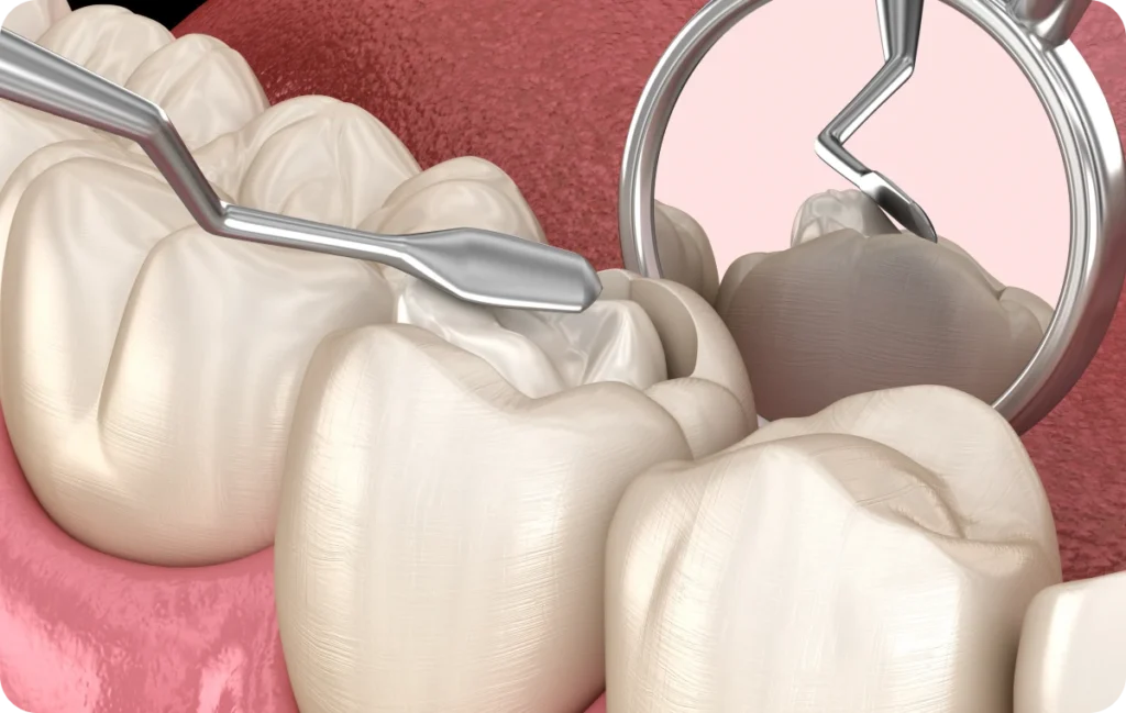 composite dentistes dents dentiste lille Onlay/Inlay Cabinet OPÉRA, Chirurgiens-dentistes à Lille